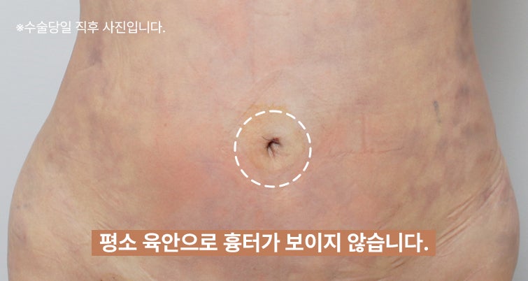 복부지방흡입 2800cc 후기, 달라진 허리라인