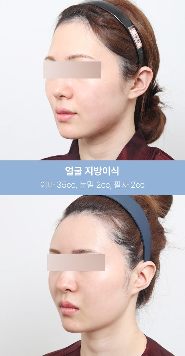 얼굴지방이식 실제 사례 (+전후사진) 사진 5