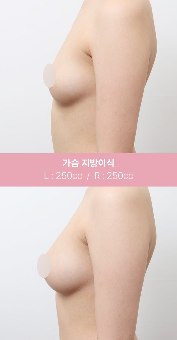 가슴 지방이식, 자연스러운 볼륨 (+실제사례) 사진 3