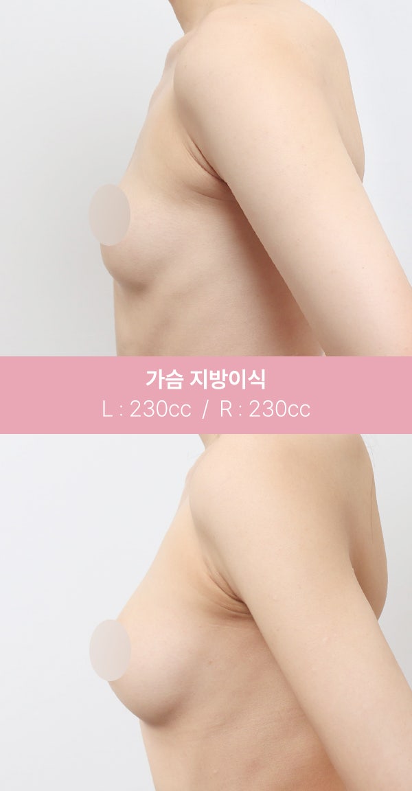 가슴 지방이식, 자연스러운 볼륨 (+실제사례) 사진 7