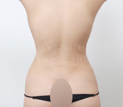 2,400cc 복부 지방흡입, 전후사진 비교 사진 8