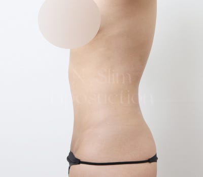 2,400cc 복부 지방흡입, 전후사진 비교 사진 6