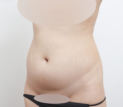 2,400cc 복부 지방흡입, 전후사진 비교 사진 3
