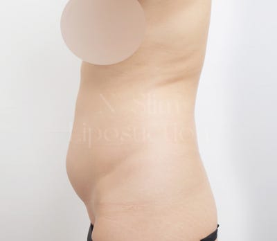 2,400cc 복부 지방흡입, 전후사진 비교 사진 5