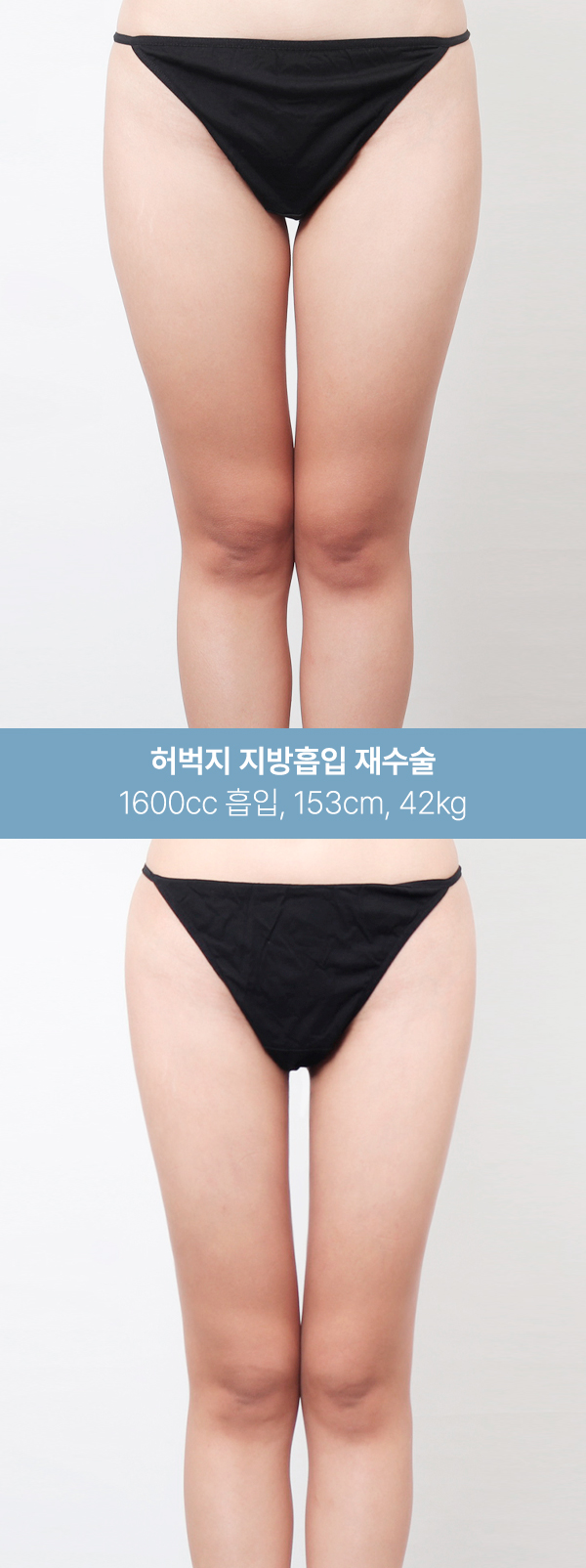 1600~2000cc 흡입 후 달라진 허벅지 라인 사진 2