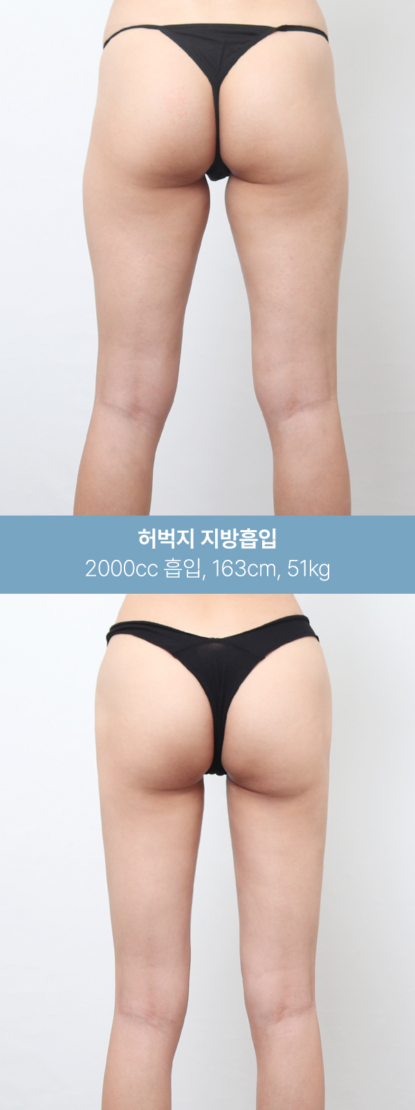 1600~2000cc 흡입 후 달라진 허벅지 라인 사진 6