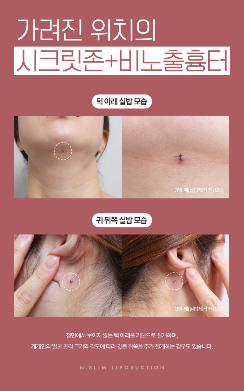 이중턱 지방흡입 50cc, 수술 전부터 3개월차까지 사진 8