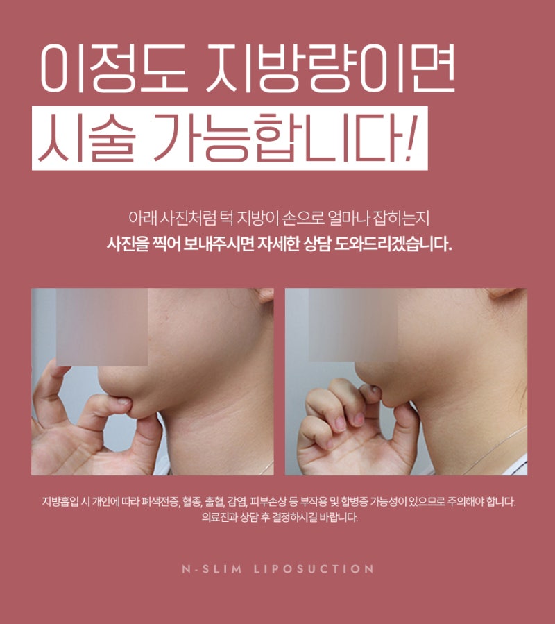 이중턱 지방흡입 50cc, 수술 전부터 3개월차까지 사진 9