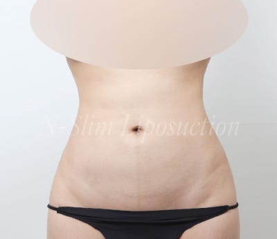 복부 지방흡입 2400cc 실제 사례 사진 3