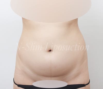 복부 지방흡입 2400cc 실제 사례 사진 2