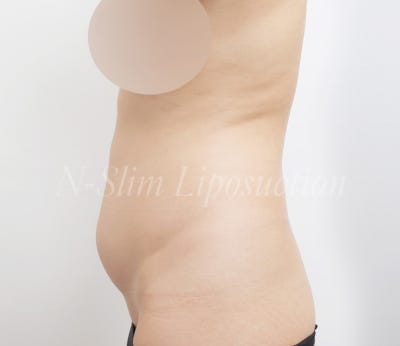 복부 지방흡입 2400cc 실제 사례 사진 6