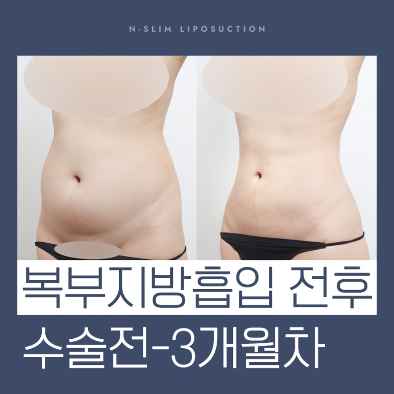 복부 지방흡입 2400cc 실제 사례